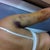 Bruising on right arm- 1 week post-op