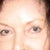 2 years after laser removal of most of tattooing.  It took months of laser, and they're still not completely gone!  My eyebrows still look odd and there's scarring. I have to cover leftover tattooing and scars with concealer.