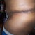Day 4 Post-Op incision