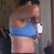 Left - three days post op