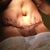 What is up with the dimples and fat thick scar is any of this similar I anyone else? No drain with the quilting stitching