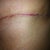 left side of my scar before I started to use ScarAway