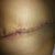 right side of my scar before I started to use ScarAway