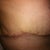 right side of my scar after wearing ScarAway for 12 hours