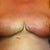 Day 10 post op:
After nipple coverings were removed