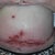 A Hard Swollen Abd. 6 months Post Smart Lipo.  The underwear use to ride at my hips!