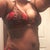 This is the high scar side. PO 10 mos. Pre-revision. We are shooting to get this scar down below this bathing suit and to get rid of the extra fat remaining.