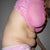 This photo helps remind me why Im having surgery!