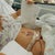 Day 2 post op - not much brusing yet...
