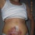 7 days post op. Lots of liposuction over tummy caused this bruising.