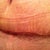The day the steri- strips were removed. Forgive the pubes.