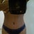 14 days after vaser lipo