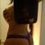 14 days after vaser lipo