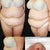 Before photo at ps & what was removed 12 lbs :(