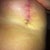 left vertical scar at 7 weeks
