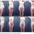 Abdominoplasty and liposuction of the back, abdomen and thighs.  Thigh lift and skin removal.