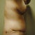 10 days post-op