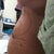 My back "non-contour" before surgery