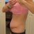 This was between 4-5 weeks. Much rounder than pre-op and getting rounder all the time.