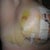 RIGHT SIDE, DAY 5 POST OP