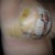 RIGHT SIDE, DAY 5 POST OP