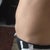 2 months post procedure.  Notice that this right side has more bulges. :(