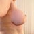 Post-op (day 10). I find myself wishing they were even smaller. But, it's still early and hard to know how they will look when the swelling subsides and the breast drops a little bit more to a more normal position.