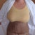 Front view 24 hrs post op