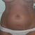 Abdomen before (love handles, too)