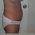 Abdomen before