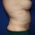 2 days preop