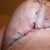 Post op day 1-- righty