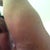 just after the procedure - left arm