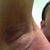 just after the procedure - right arm