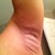 3 days later - left arm