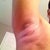 3 days later - right arm