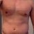 3 days later - swelling in the waist