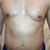 5 days later - severe swelling in torso/waist