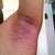 7 days later - left arm