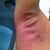 7 days later - right arm