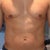 7 days later - torso/waist getting back to normal