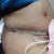 side view 9 day post op