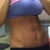 almost 2 years later and I couldnt be happier with my mini tummy tuck