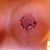 Still some healing but doing well I think