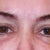 This is exactly 24 hrs after Perlane.  Minimal bruising. I didn't want to create the deception that no bruising at all occurs.  Some is normal.