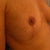 6 Week Post Op_Engorged but will relax over time.