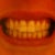 Bite, without aligners, halfway through