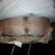 sorry about pubes but it shows the sutures well