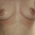 11 weeks post-op