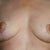 12 weeks post-op